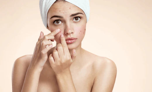 Acne? Acne! Learn about this Loathsome Skin Condition with The Minies